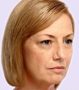 before fillers female patient angle view case 4986