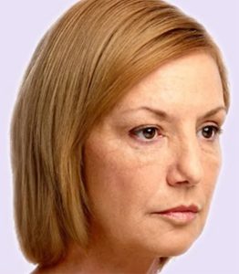 after fillers female patient angle view case 4986