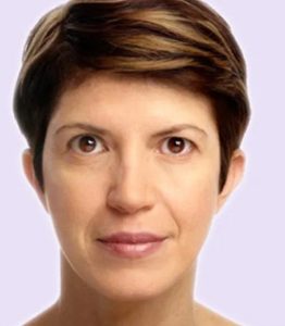 after fillers female patient front view case 4989