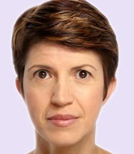 before fillers female patient front view case 4989