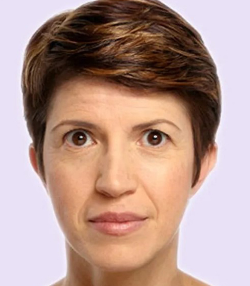 before fillers female patient front view case 4989