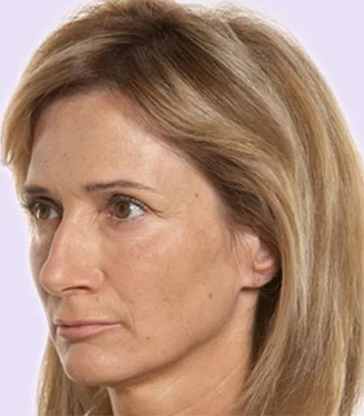 after fillers female patient angle view case 4992