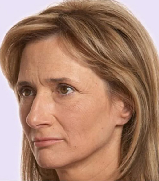 before fillers female patient angle view case 4992