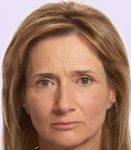 before fillers female patient front view case 4992