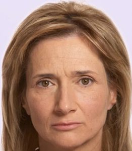 before fillers female patient front view case 4992