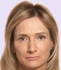 after fillers female patient front view case 4992