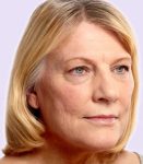 before fillers female patient angle view case 4997