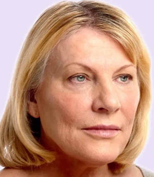 after fillers female patient angle view case 4997