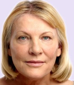 after fillers female patient front view case 4997