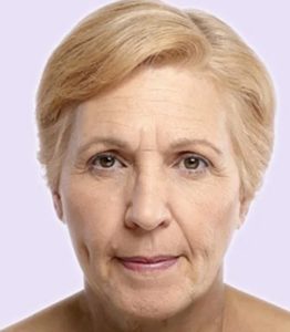before fillers female patient front view case 5002