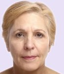 after fillers female patient front view case 5002