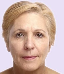 after fillers female patient front view case 5002