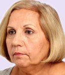 before fillers female patient angle view case 5007