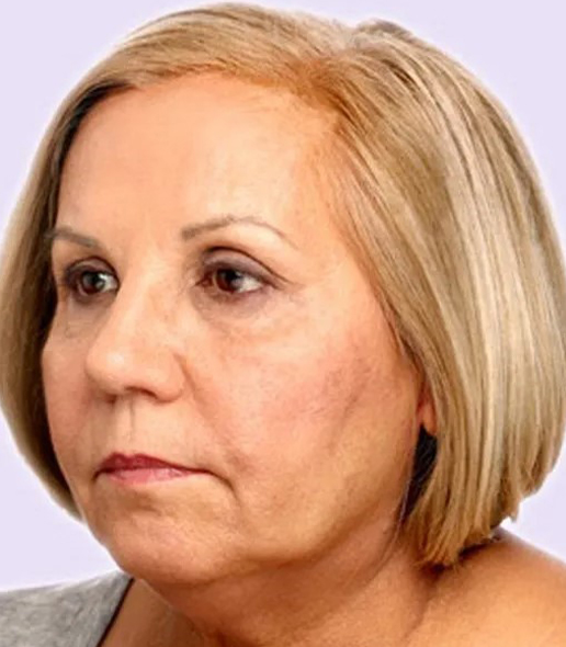 after fillers female patient angle view case 5007