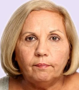 before fillers female patient front view case 5007