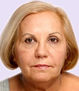 after fillers female patient front view case 5007