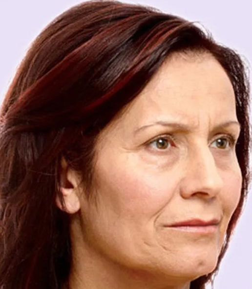 before fillers female patient angle view case 5012