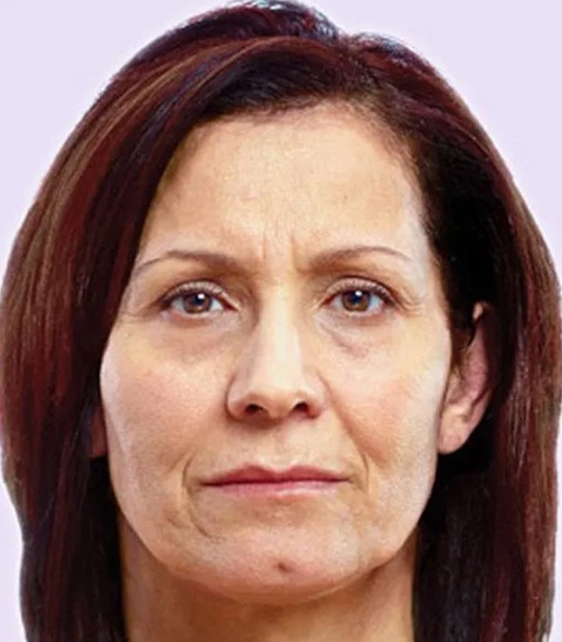 before fillers female patient front view case 5012