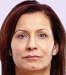 after fillers female patient front view case 5012