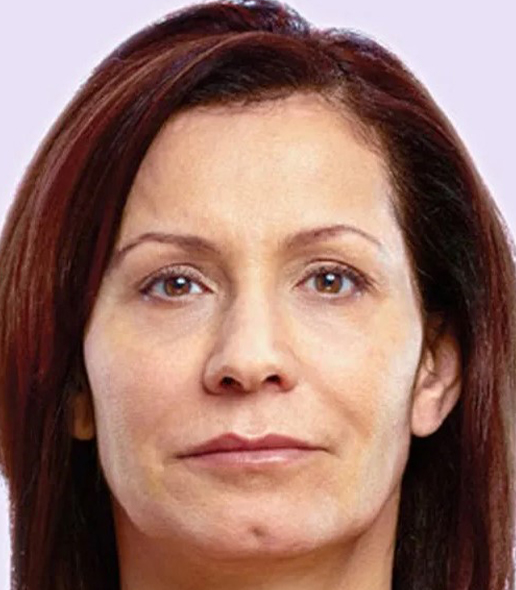 after fillers female patient front view case 5012