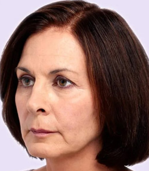 before fillers female patient angle view case 5017