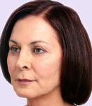 after fillers female patient angle view case 5017