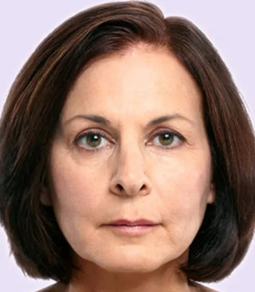 before fillers female patient front view case 5017