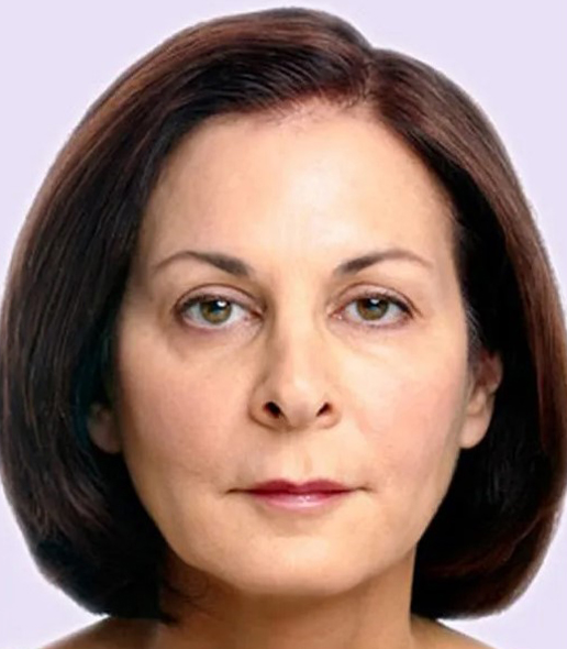after fillers female patient front view case 5017
