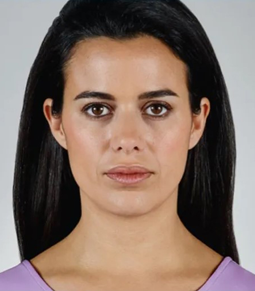 before fillers front view female patient case 5037