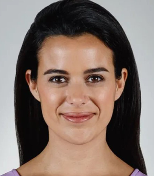 before fillers front view female patient case 5037