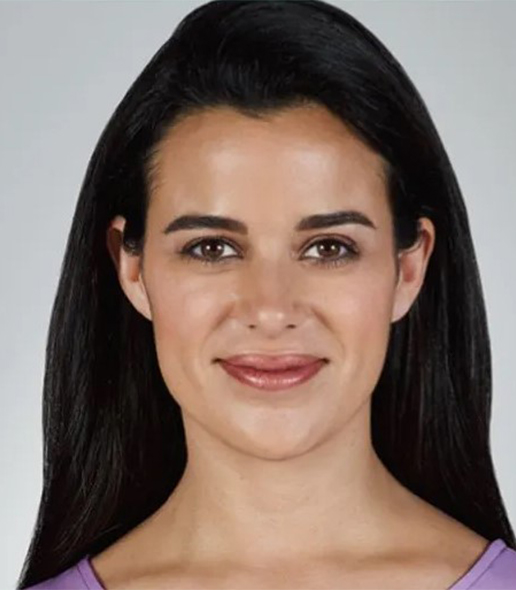 after fillers front view female patient case 5037