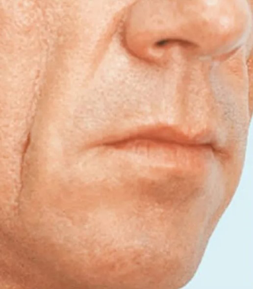 before fillers male patient angle view case 5051