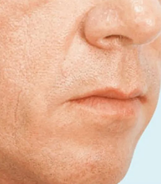 after fillers male patient angle view case 5051