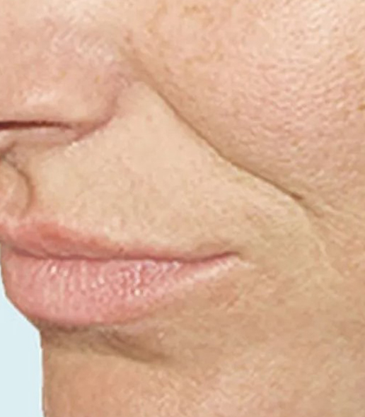 before fillers female patient angle view case 5054