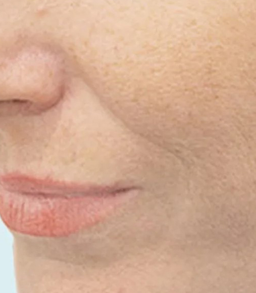 after fillers female patient angle view case 5054