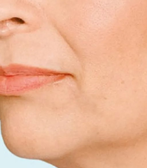 before fillers female patient angle view case 5057