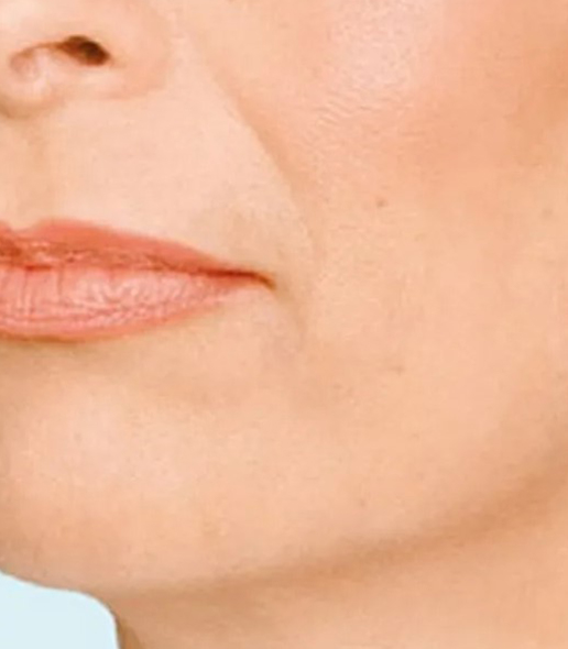after fillers female patient angle view case 5057