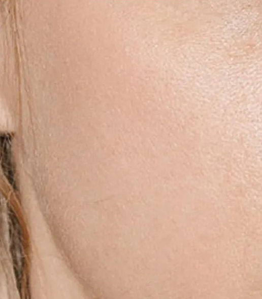 after fillers female patient angle view case 5063