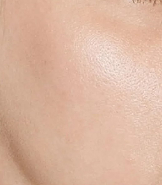 before fillers female patient angle view case 5063