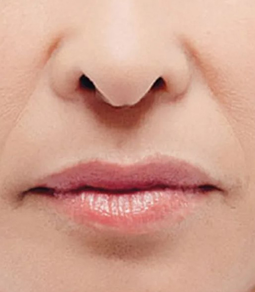 before fillers female patient front view case 5066