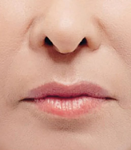 after fillers female patient front view case 5066