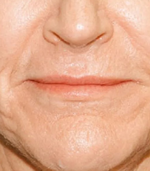 before fillers female patient front view case 5069