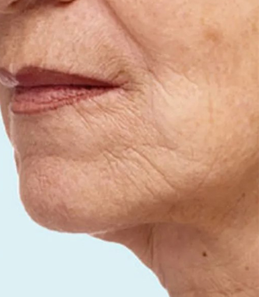 before fillers female patient angle view case 5072
