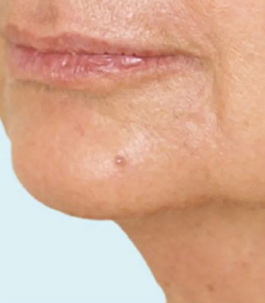 after fillers female patient angle view case 5072
