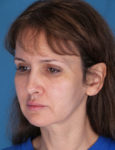 before laser skin resurfacing left angle view female patient case 1891