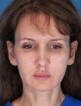 before laser skin resurfacing front view female patient case 1891
