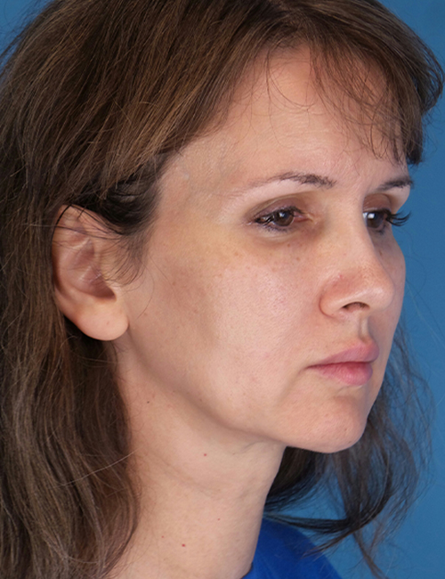 before laser skin resurfacing right angle view female patient case 1891