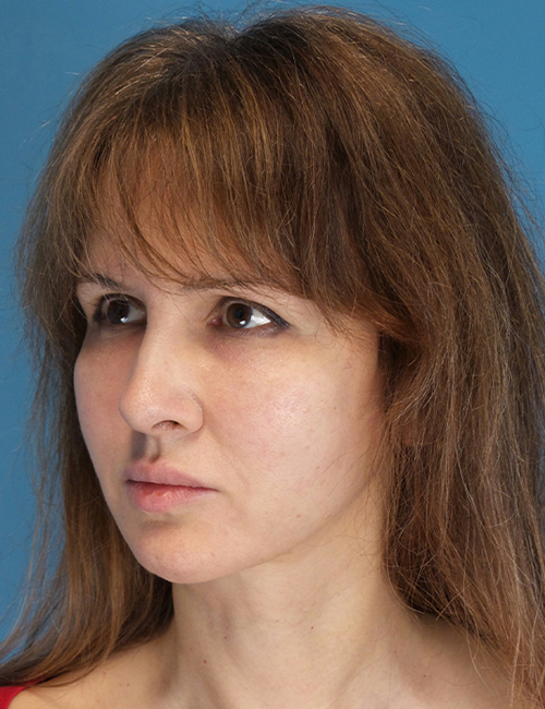 after laser skin resurfacing left angle view female patient case 1891