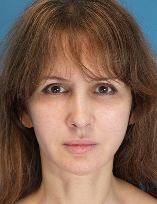 after laser skin resurfacing front view female patient case 1891