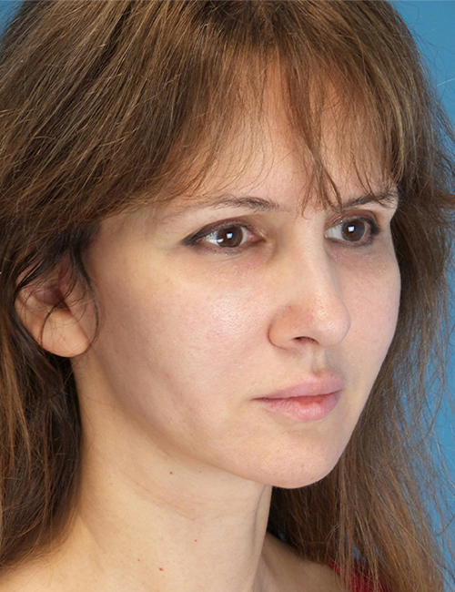 after laser skin resurfacing right angle view female patient case 1891